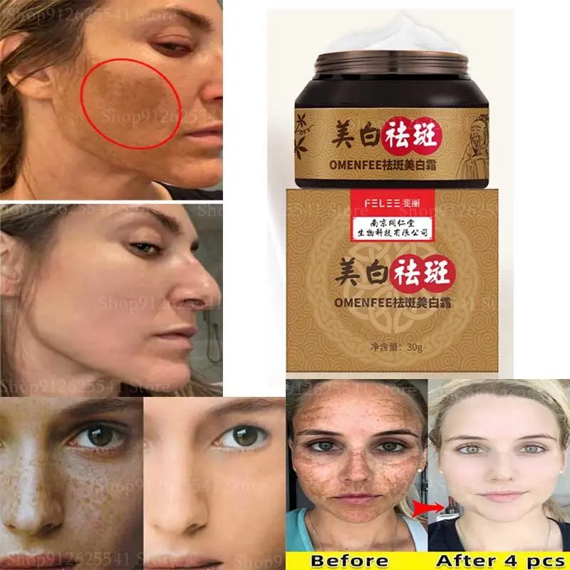 Fast Whitening Freckles Cream Facial Spots Skin Dark Spot Freckles Remove Cream Melanin Anti-Pigmentation Improve Dullness