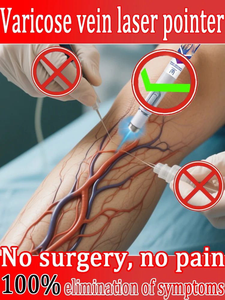 

2nd generation varicose vein laser eliminates vasculitis and phlebitis, relieves spider leg pain, laser pointer for treatment