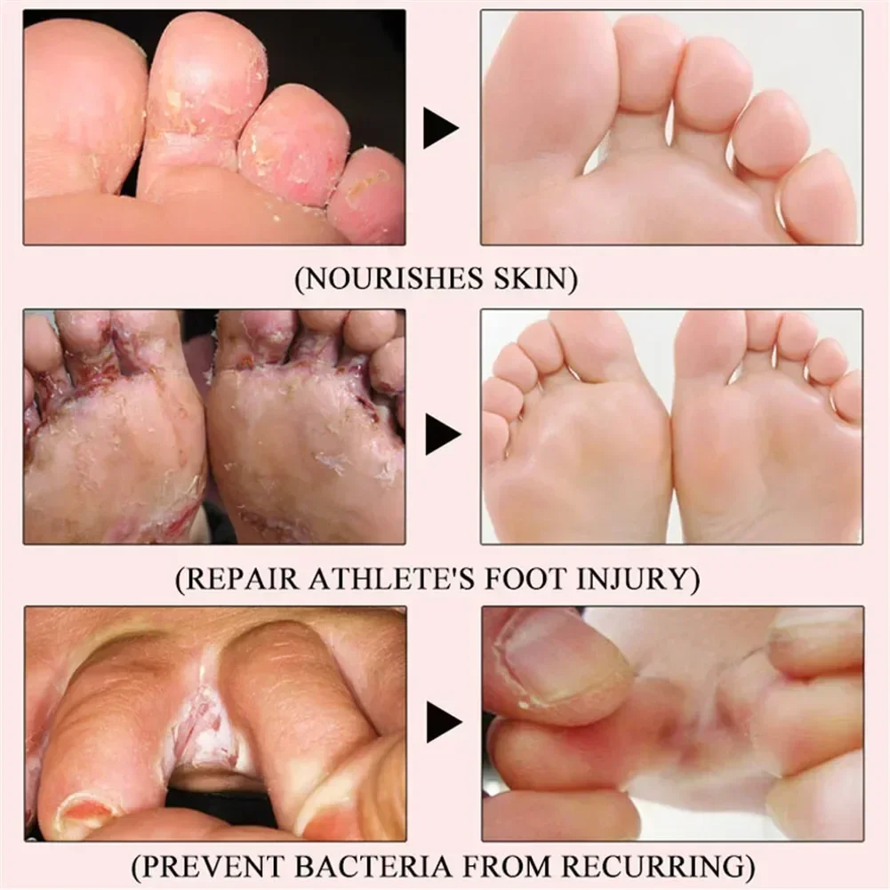 Foot Repair Spray Inhibit Fungi Infections Hand Tinea Toe Treatment El for Cracked Heel Peeling Blister Repairing Feet 족저근막염