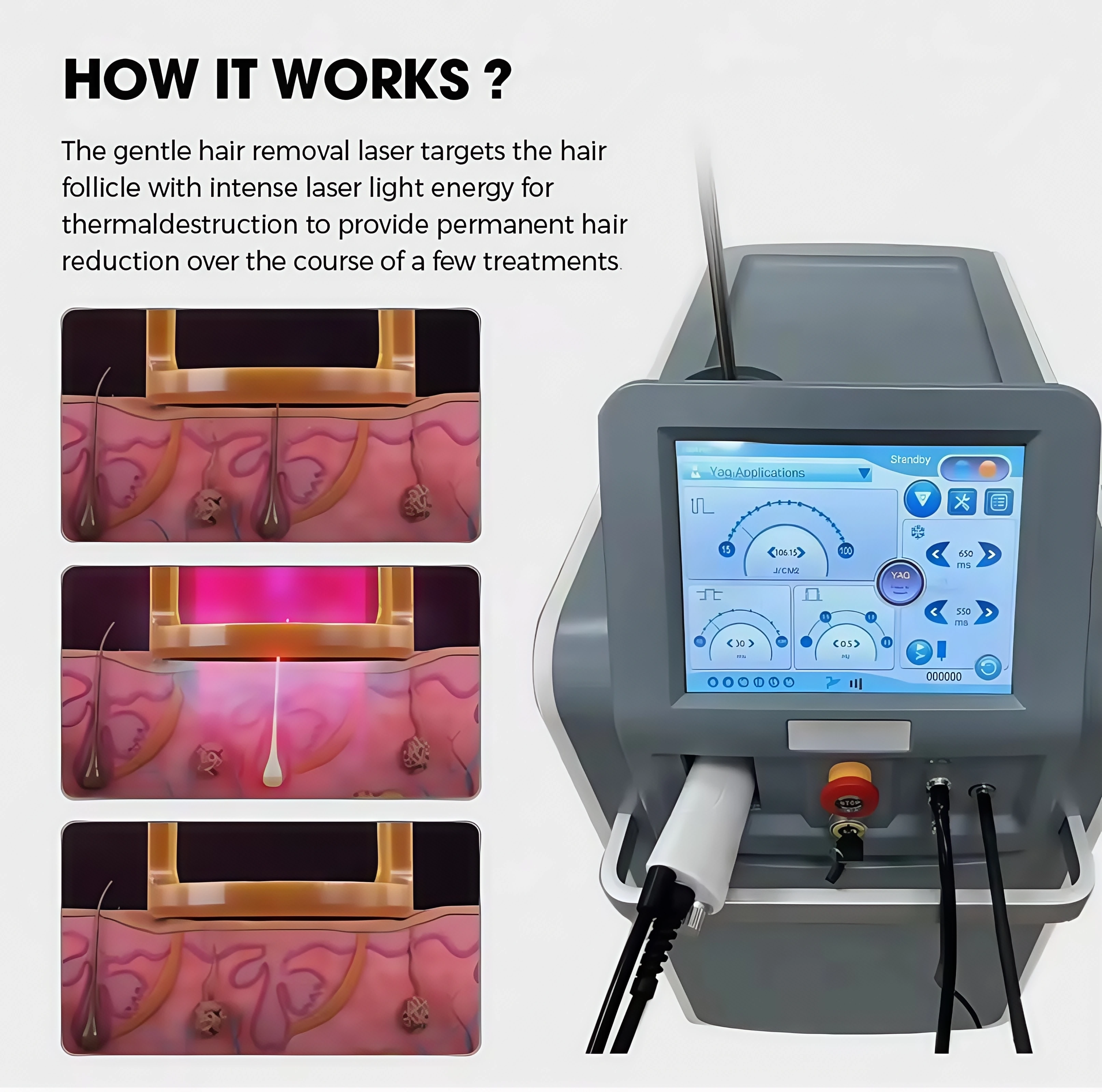 EMTTNEO High quality 1064nm painless hair removal Clinic 755NM alexandrite machine