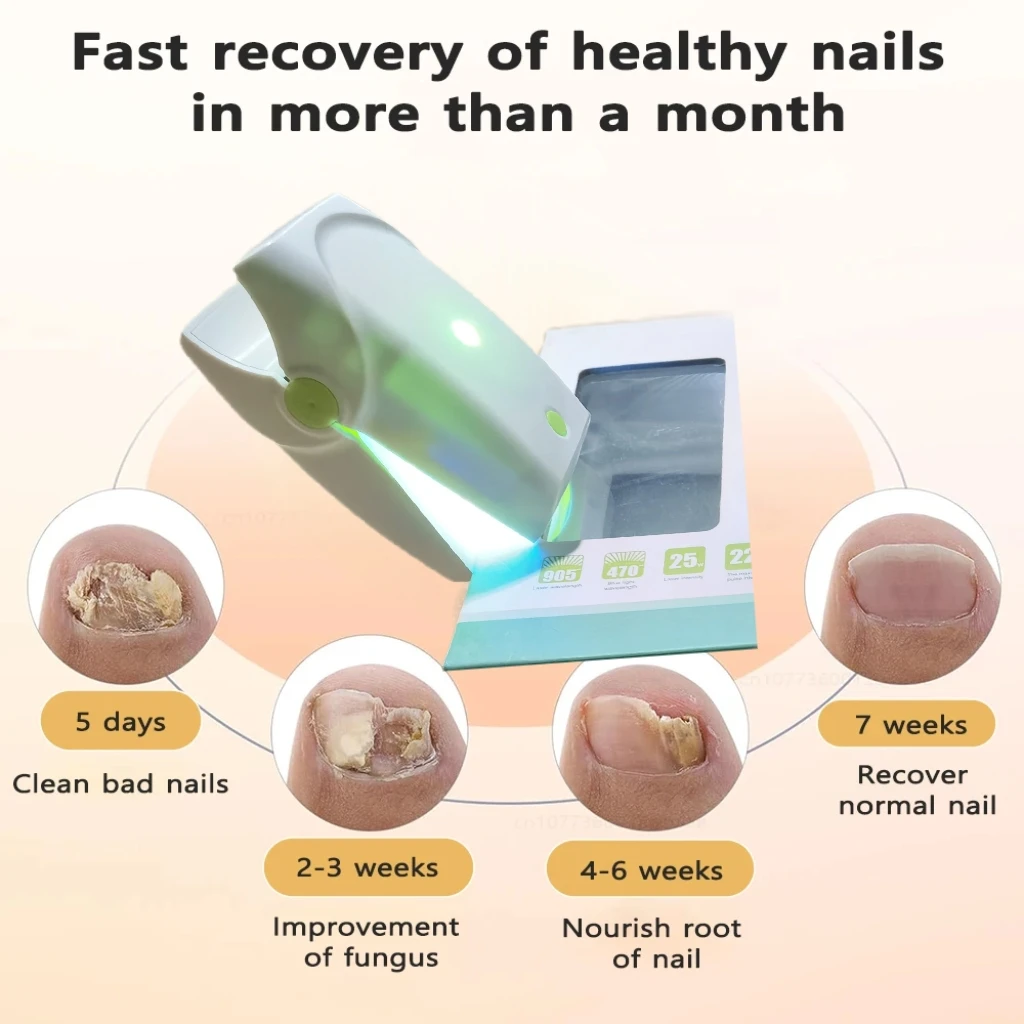 

905nm Professional Nail Care Laser Device USB Rechargeable for Toenails & Fingernails Onychomycosis Support Machine