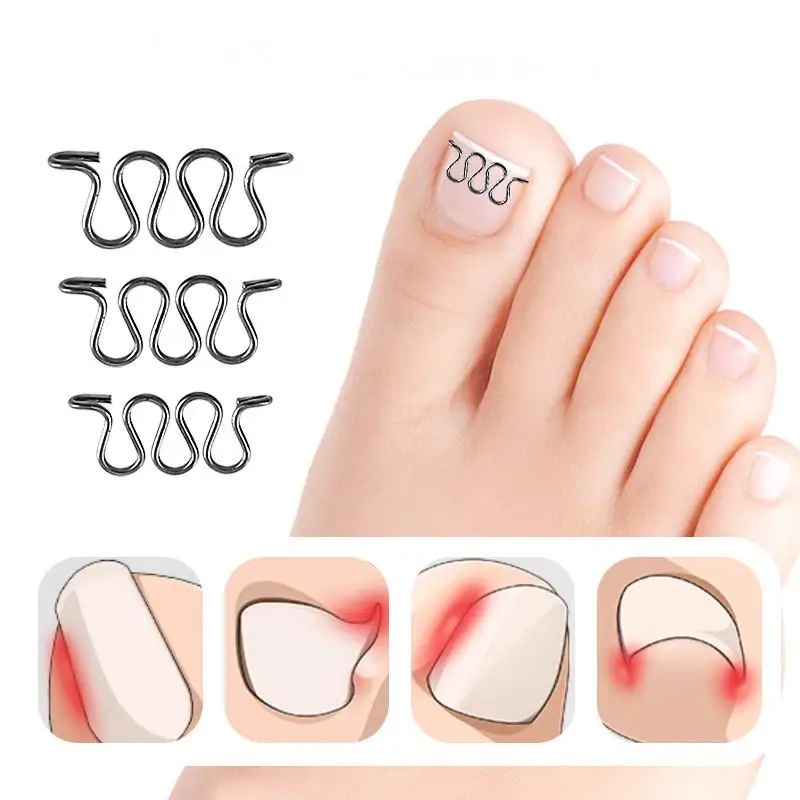 Ingrown Toenail Correction Wire Stainless Steel Fixing Tool for Curved Ingrown Nails Quick Relief at Home