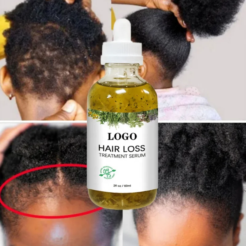 

60ml Fast Hair Regrowth Serum Black Seed Castor Hair Growth Serum Oil Thick Hair Fast Growth For Black Women