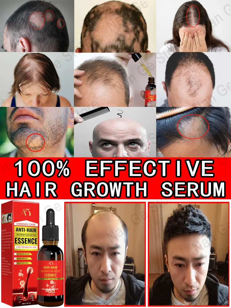 

Plant essence hair growth spray products for men and women, ginger anti-hair loss, rapid regeneration, thickening, oil control,