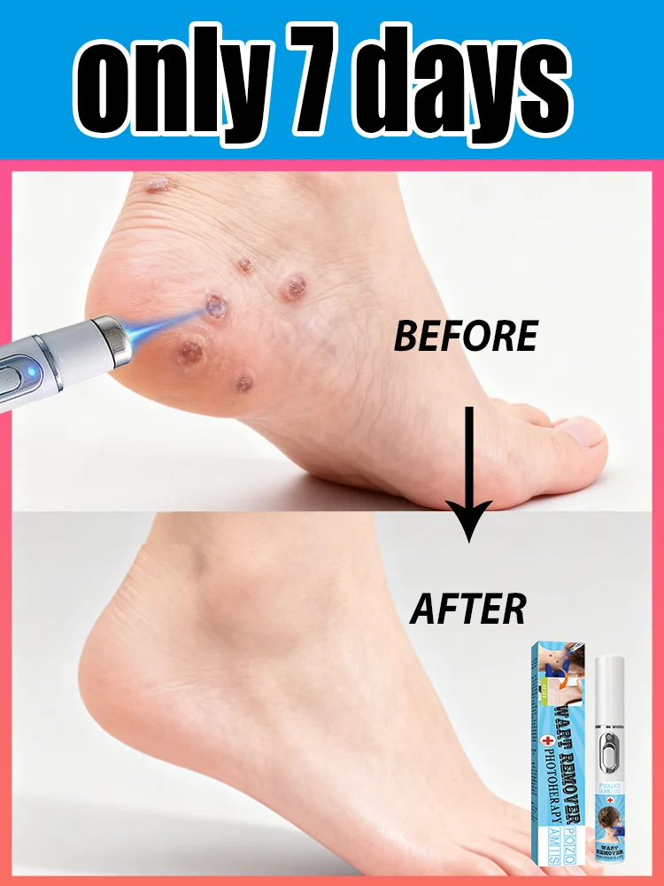 

ʙʟᴜᴇ ʟɪɢʜᴛ ᴘᴇɴ sᴏʟᴠᴇ ᴡᴀʀᴛs, ʜᴏᴛ sᴀʟᴇ ᴡᴀʀᴛ ᴄᴀʀᴇ ᴛᴏᴏʟs