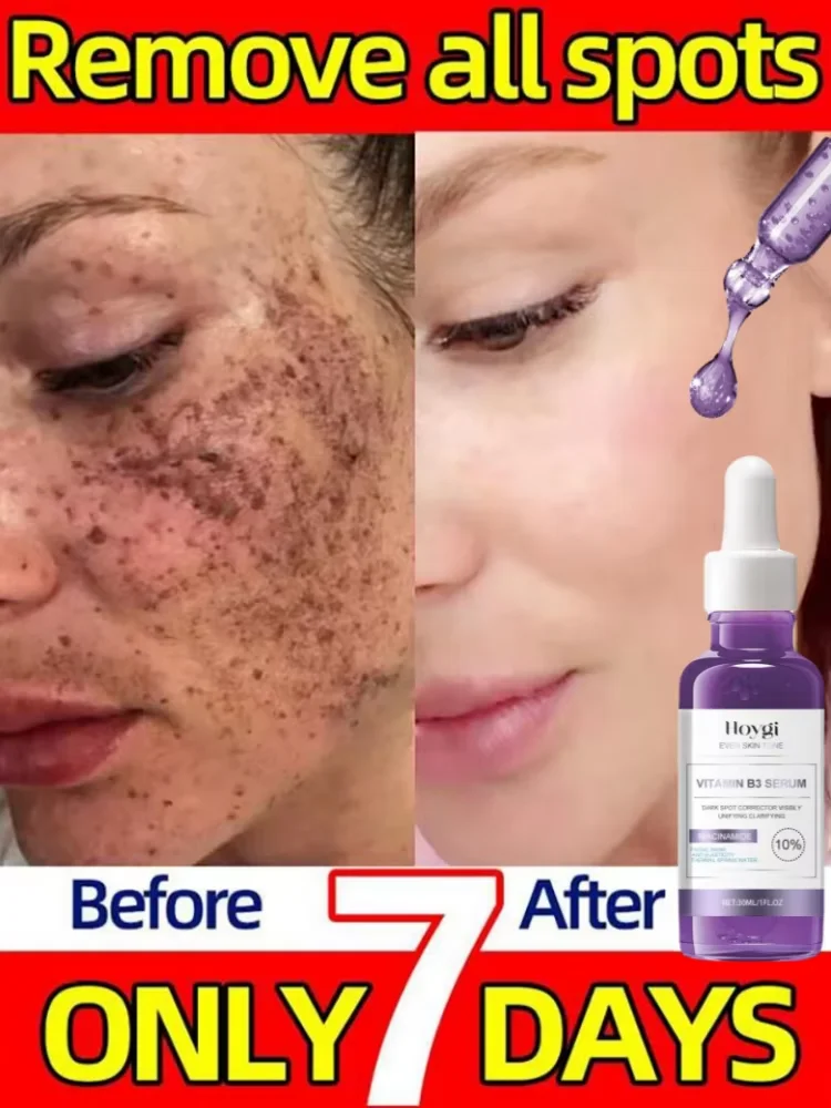 

Powerful Dark Spots Remover B3 Whitening Serum Freckle Melanin Correcting Anti Pigmentation Brighten Skin Beauty Care Products