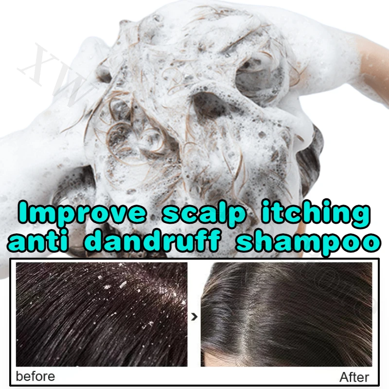 

Amino Acid Anti-dandruff Shampoo Improves Scalp Itching