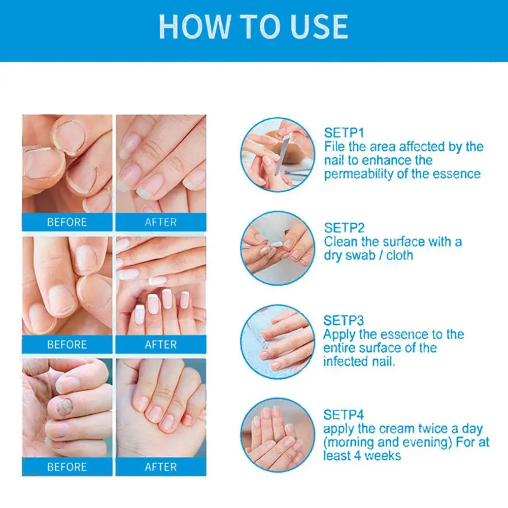 Tratamento do fungo para unhas, Reparar unhas dos pés, Onicomicose Paroníquia, Anti Infecção, Toe Nail Remoção de fungos, A4B1