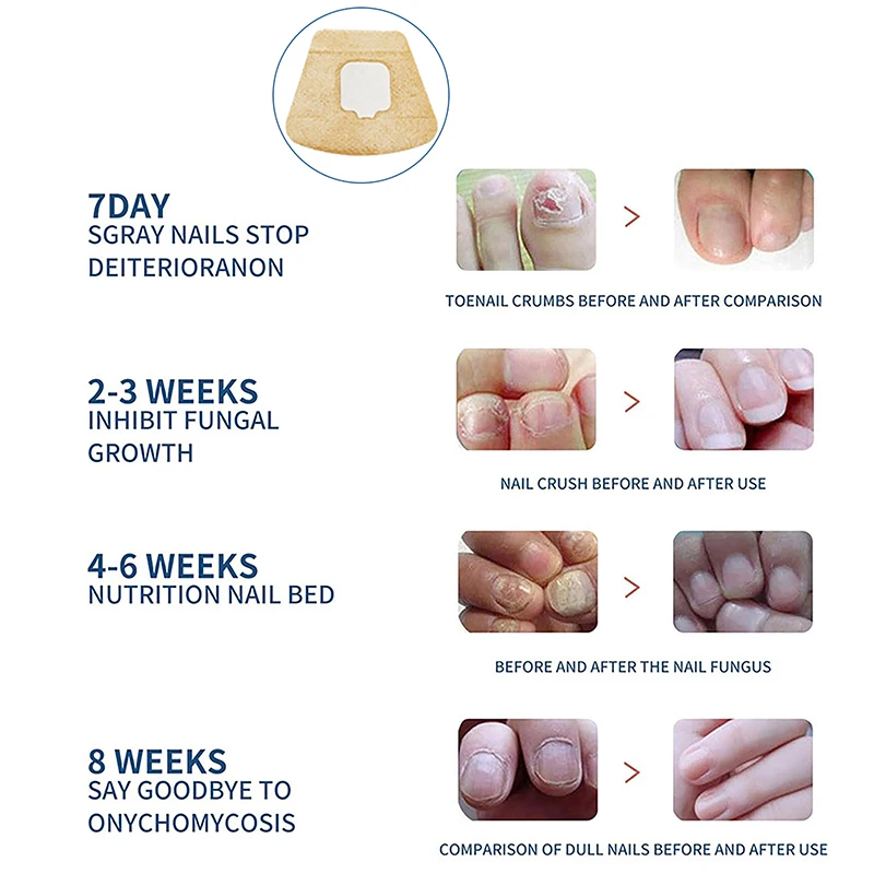 هيدروجيل علاج الأظافر التصحيح مكافحة الفطريات مسمار تصحيح ملصقات نام أظافر الرعاية بارونيشيا مكافحة العدوى رقعة إصلاح الإطارات