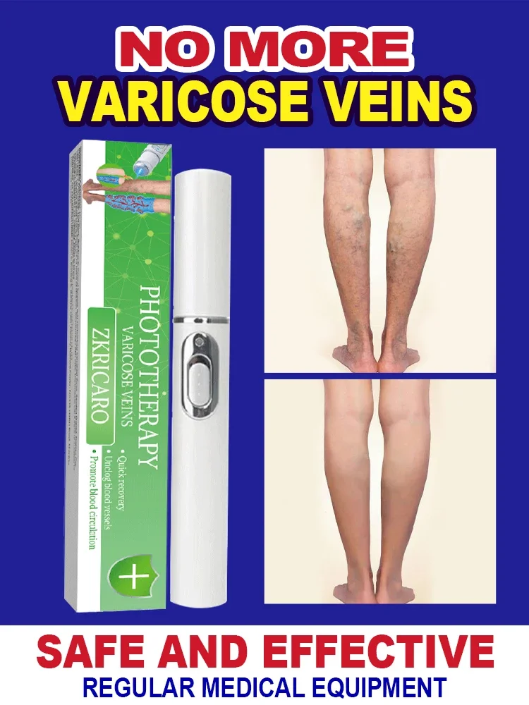 

Powerful Laser Therapy for Moderate Varicose Veins, Relieve Pain and Improve Circulation for Both Men and Women