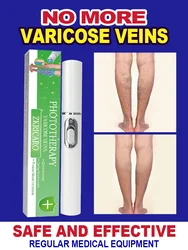 Powerful Laser Therapy for Moderate Varicose Veins, Relieve Pain and Improve Circulation for Both Men and Women