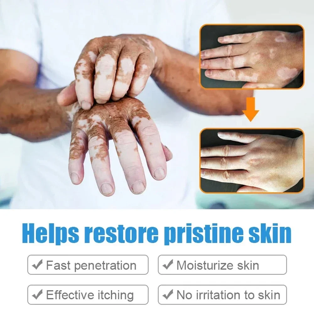 Vitiligo Repair Get Rid Of Ringworm White Spots Get Rid Of Skin Vitiligo Eliminate Vitiligo Better Body Skin