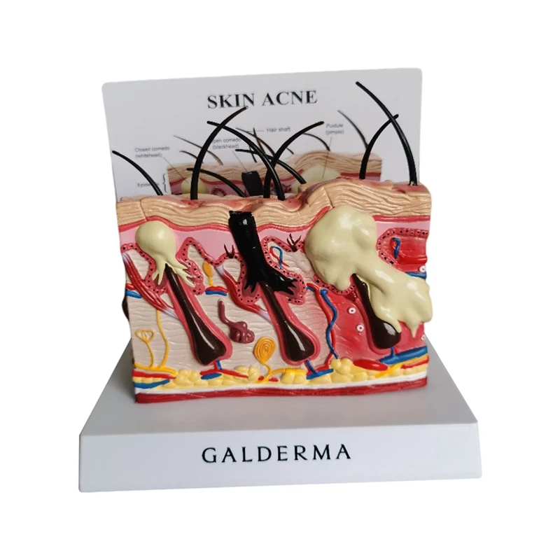 

Анатомическая модель, Анатомия человека, нормальная и обычная кожа от акне, физиологическое образование