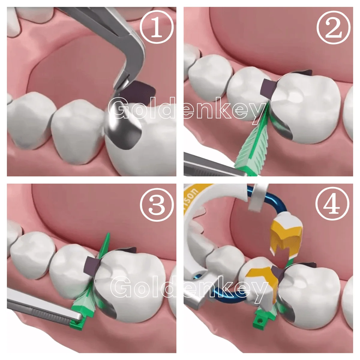 Kliny dentystyczne StrataG Miękkie uszczelnienie szyjne Diastema Matryca kompozytowa Bardzo małe średnie duże Autoklawowane 134 ℃