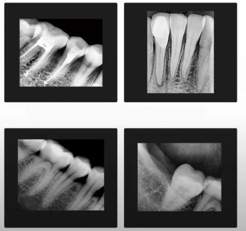 Rivelatore dentale con sensore a raggi X intraorale digitale per conteggio fotoni a bassa dose, dimensioni 0,8