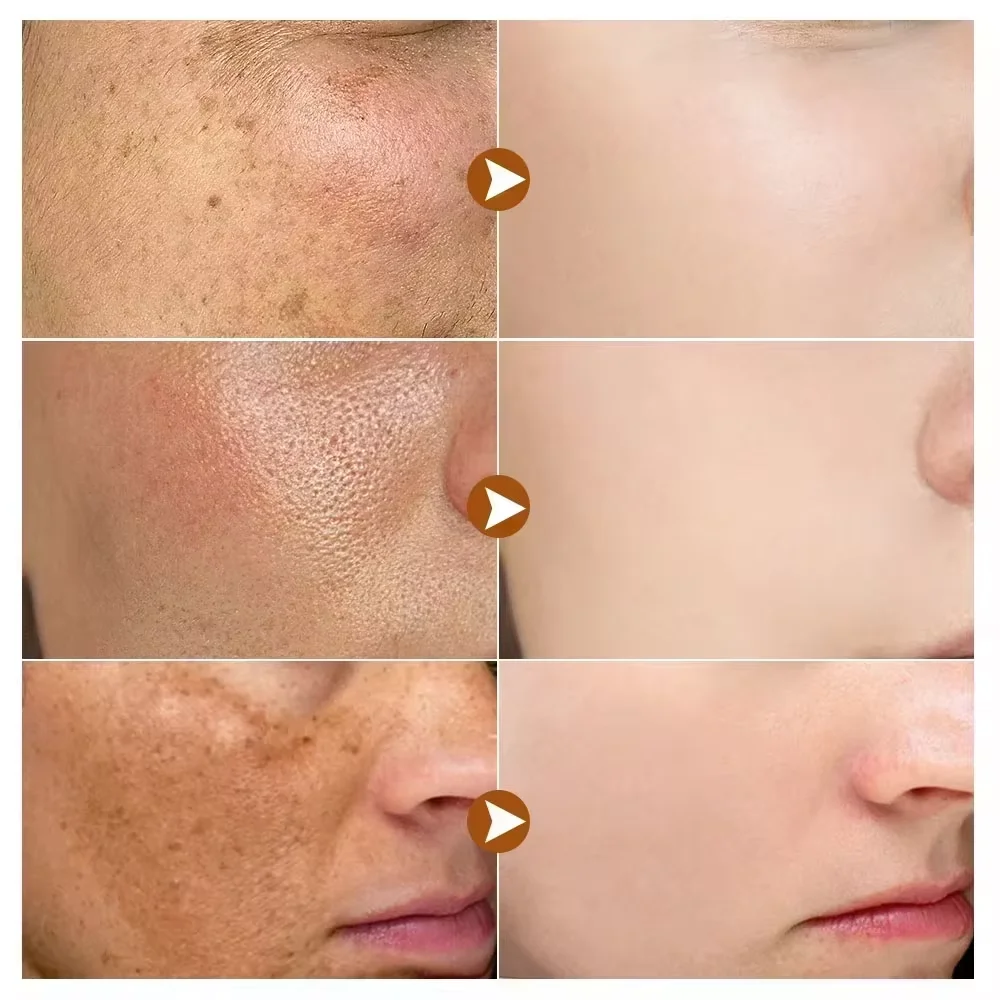 قوية تبييض النمش كريم وجه مصحح البقع الداكنة إزالة الكلف تتلاشى الميلانين التصبغ سطع منتجات العناية بالبشرة