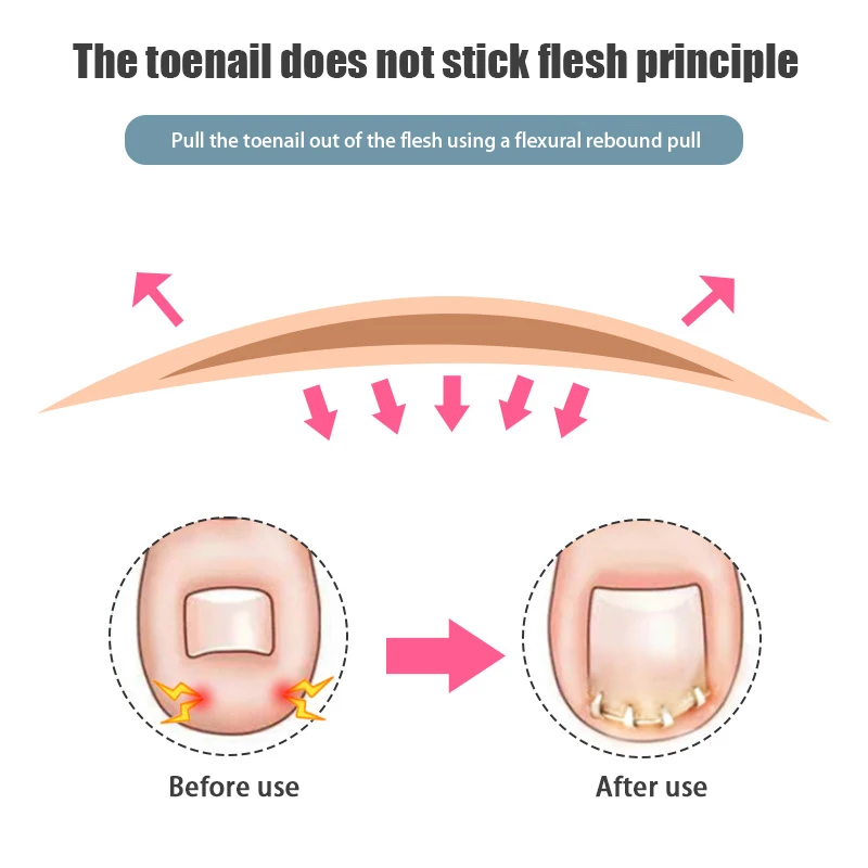 Herramienta de corrección profesional para el cuidado de los pies, Corrector de uñas encarnadas, herramientas de pedicura, tratamiento de uñas de los pies incrustado