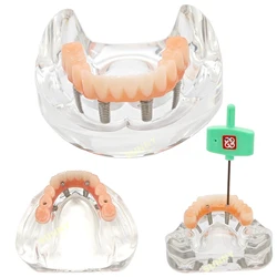 Dental Model simulation Teeth Model Lower Jaw Implant Restoration 4 Screws with Post Core Bridge Dentist Teaching Studying Demo