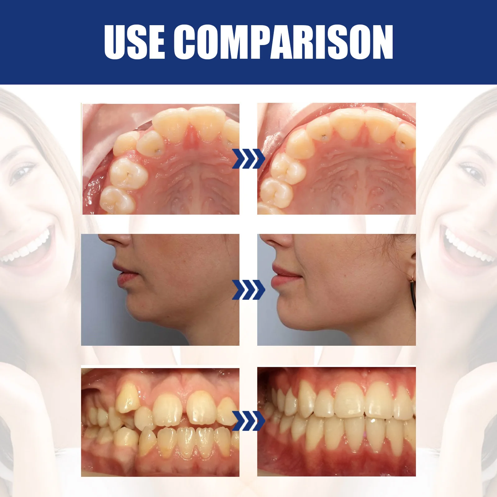 تقويم الأسنان من السيليكون ، مدرب محاذاة ، أداة تثبيت الأسنان ، واقي الفم ، محاذاة الأسنان ، محاذاة الفك ، أجهزة طب الأسنان #6