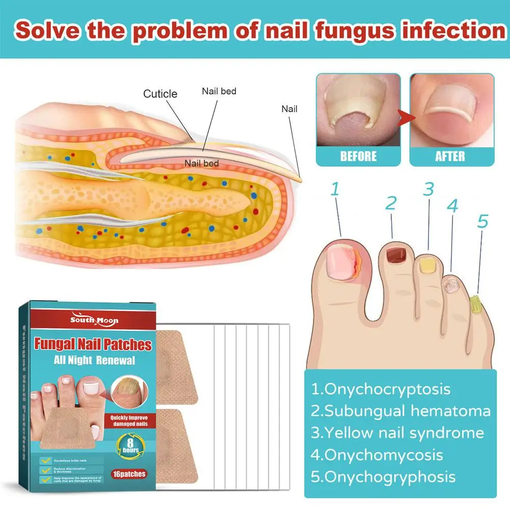 16 шт., патчи для лечения Ногтей, от грибка