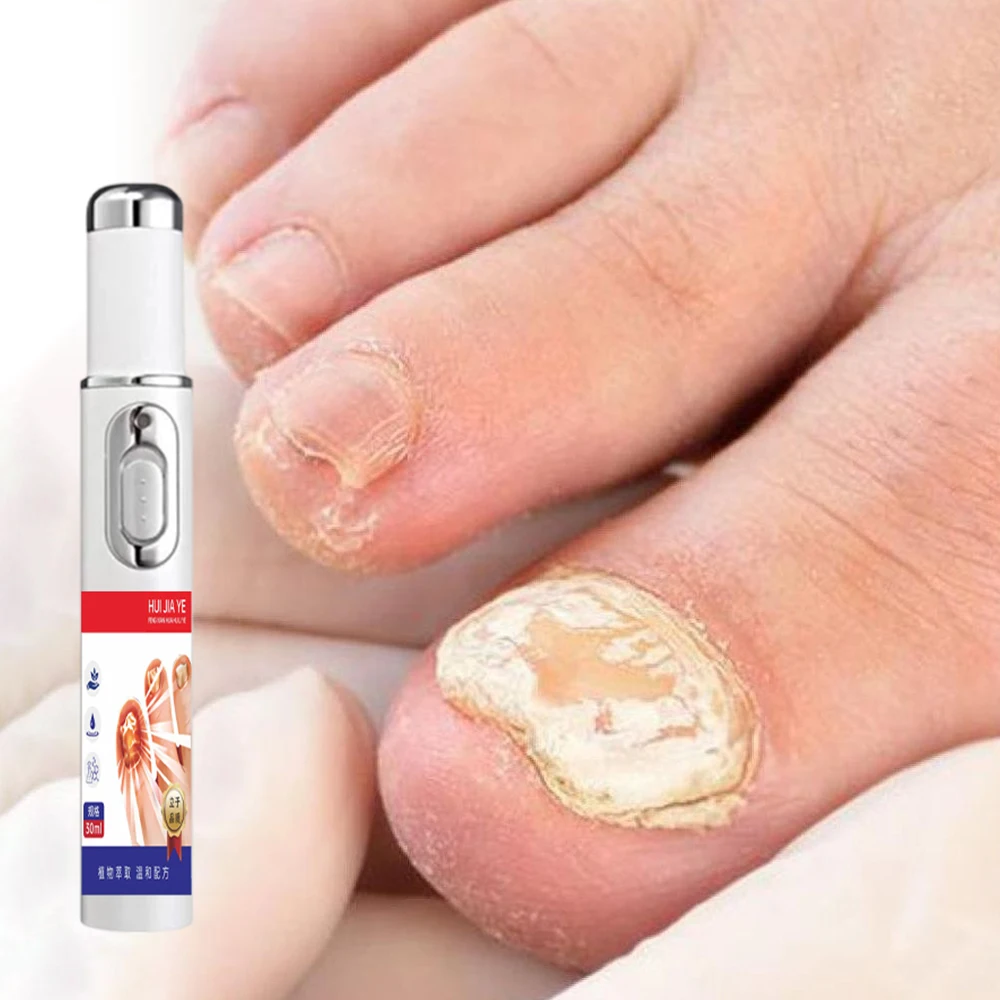 

Nail Treatment Laser Pen Painless Anti Fungus Infection Laser Pen