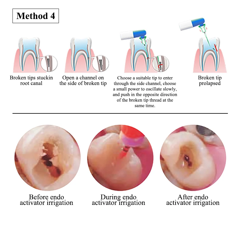 VVDental Endodontischer Wurzelkanal-Schall-Irrigator-Aktivator mit LED und 60 Stück Spitzen für die endodontische Reinigung – Zahnärztliches Instrument – Detail 7
