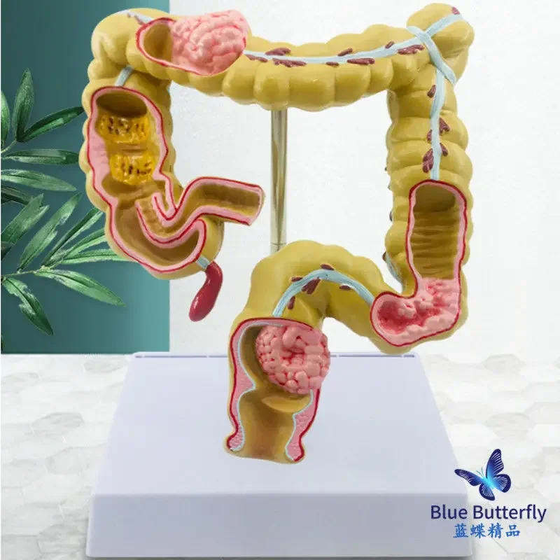 Large Intestine Pathology Model, Gastrointestinal Model, Large Intestine Disease Model, Human Colon Disease Model