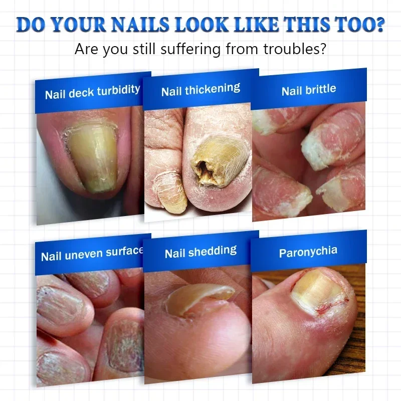 Liquide de réparation des ongles pour le renouvellement des champignons, décoloré, épaissi, écrasé, N64.F6