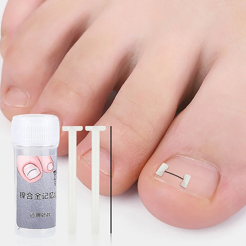 Universal Croppable Ingrown Toenail Endireitamento Clipe, Patch Elástico, Toe Nails Care, Corretor Brace, Ferramentas Pedicure