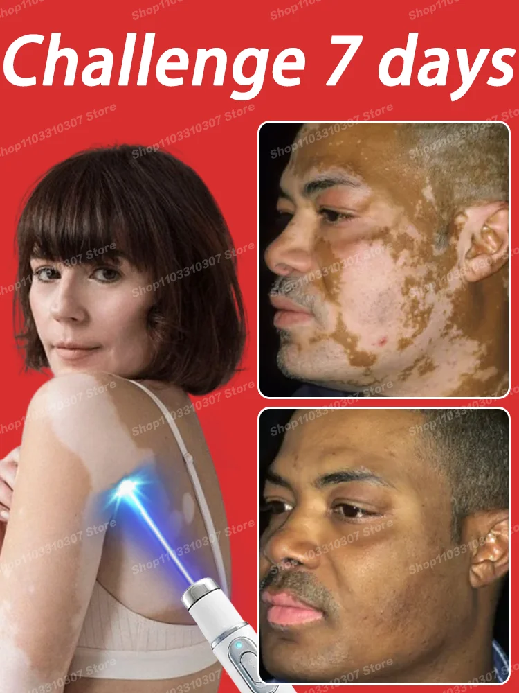 

Vitiligo White Spot Melanin Growth