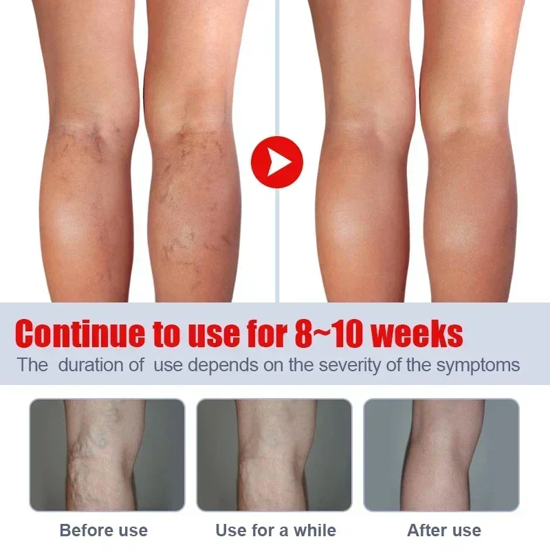 Effective Varicose Vein Relief Relieve Pain Herbal Ointment Eliminate Vasculitis Phlebitis Spider Legs Treatment Soothing