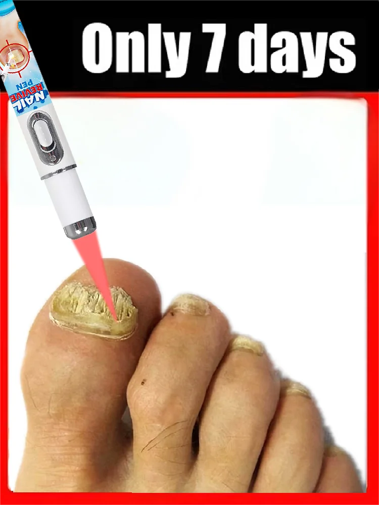

Inward Growing Nail Repair Patch, Waterproof, Inward Growing Nail Correction Sticker, Discoloration, Damage, Foot Care Tool,2025