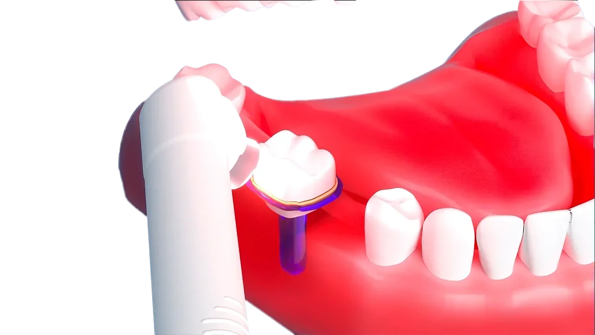 جهاز Denta Light PDT-630 لتعقيم آلة معالجة اللثة والأسنان