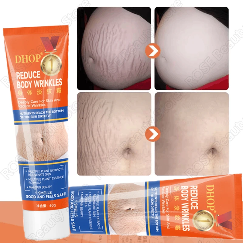 Creme de Remoção Permanente de Estrias, Gestantes Gestantes, Gravidez, Anti-Rugas, Reparação Suave, Pele Reafirmante, Cuidados com a Pele Corporal