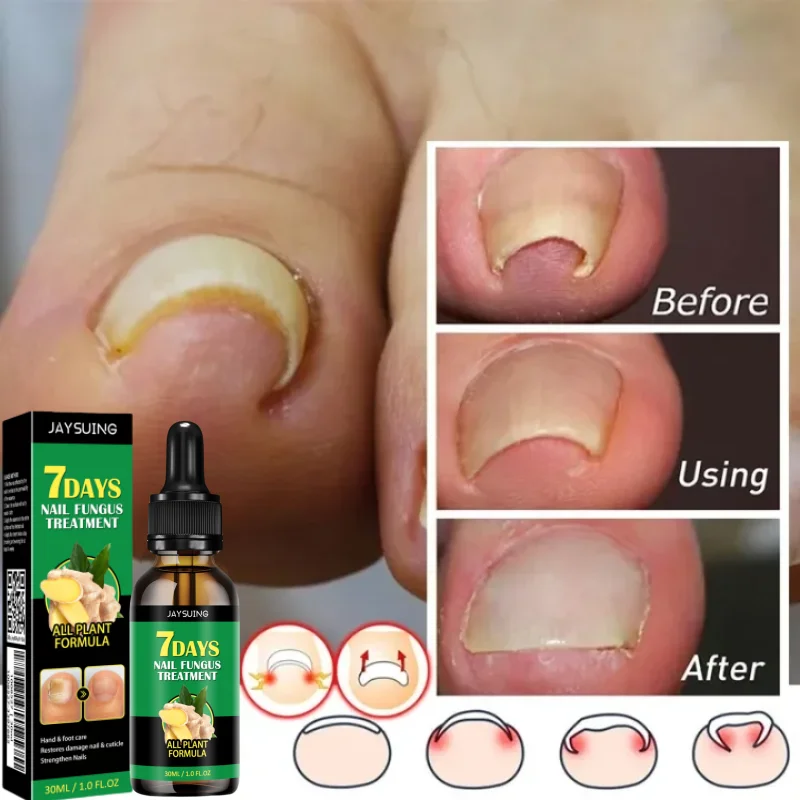 Nail Repairing Liquid Essence Hand Care Foot Fungal Removal Repair Serum Anti-infective Paronychia Nail Polish Repair Products