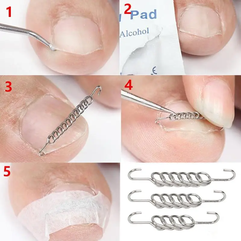 Ferramentas corretoras de unhas encravadas, pedicure, recuperação, tratamento de unhas encravadas, profissional, correção de unhas encravadas, ferramenta de cuidados com os pés