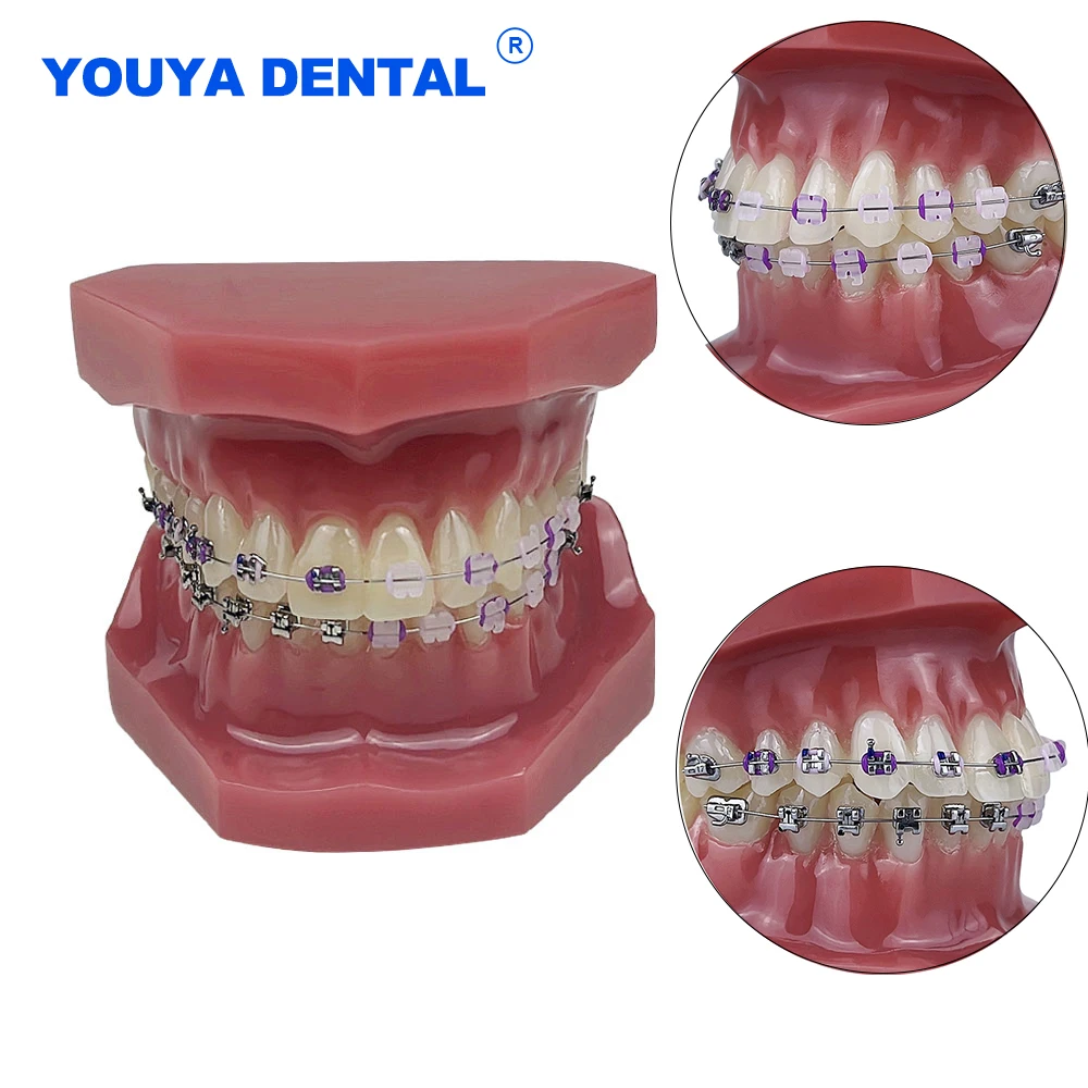 Dental Orthodontic Resin Teeth Model with Metal and Ceramic Brackets Ligature Ties with Self-locking for Orthodontic Treatment