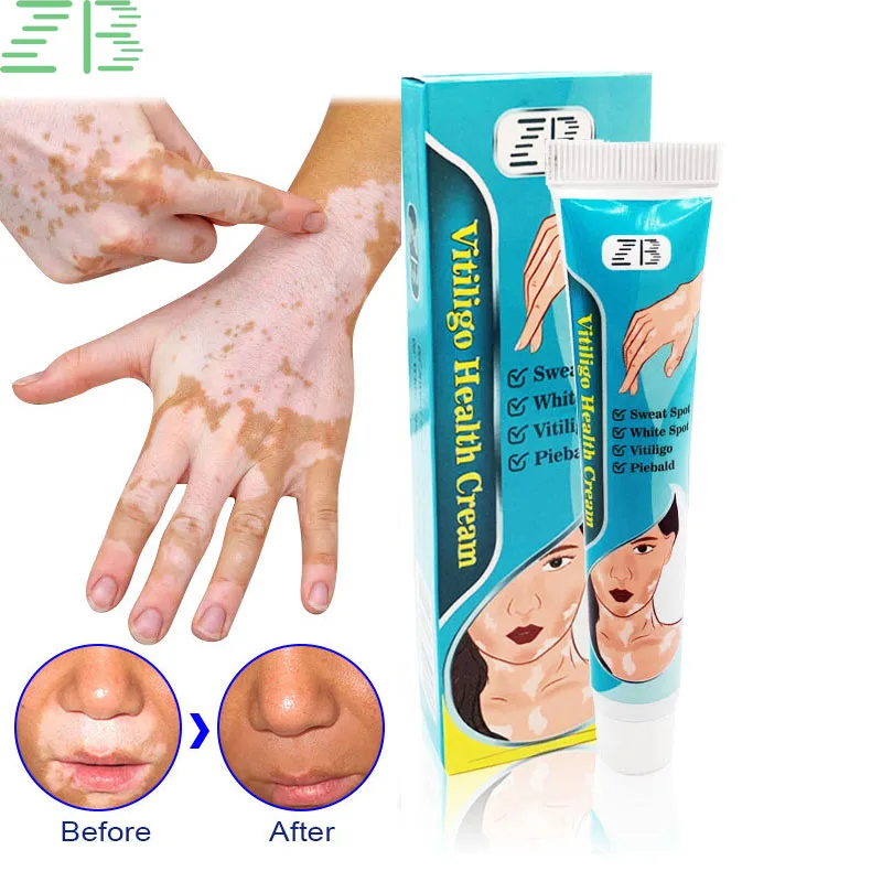 

ZB 20g Vitiligo Ointment Treatment Leukoplakia Disease Melanin Repair Cream Disease Spot Medical Pigment White Spot Repair