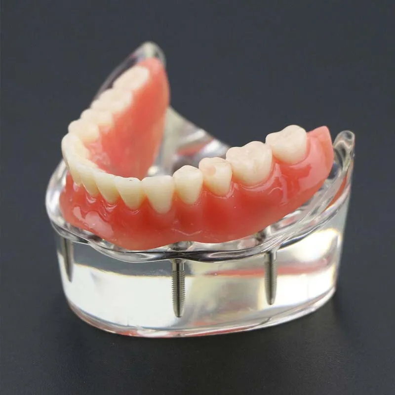 Model zębów dentystyczny z modelem Overdenture z implantem gorszy Model zębów demonstracyjny do badania dentysty Model nauczania stomatologiczne 2/4