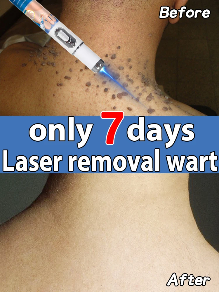 

Модернизированные бородавки 2-го поколения ремонт корня бородавок