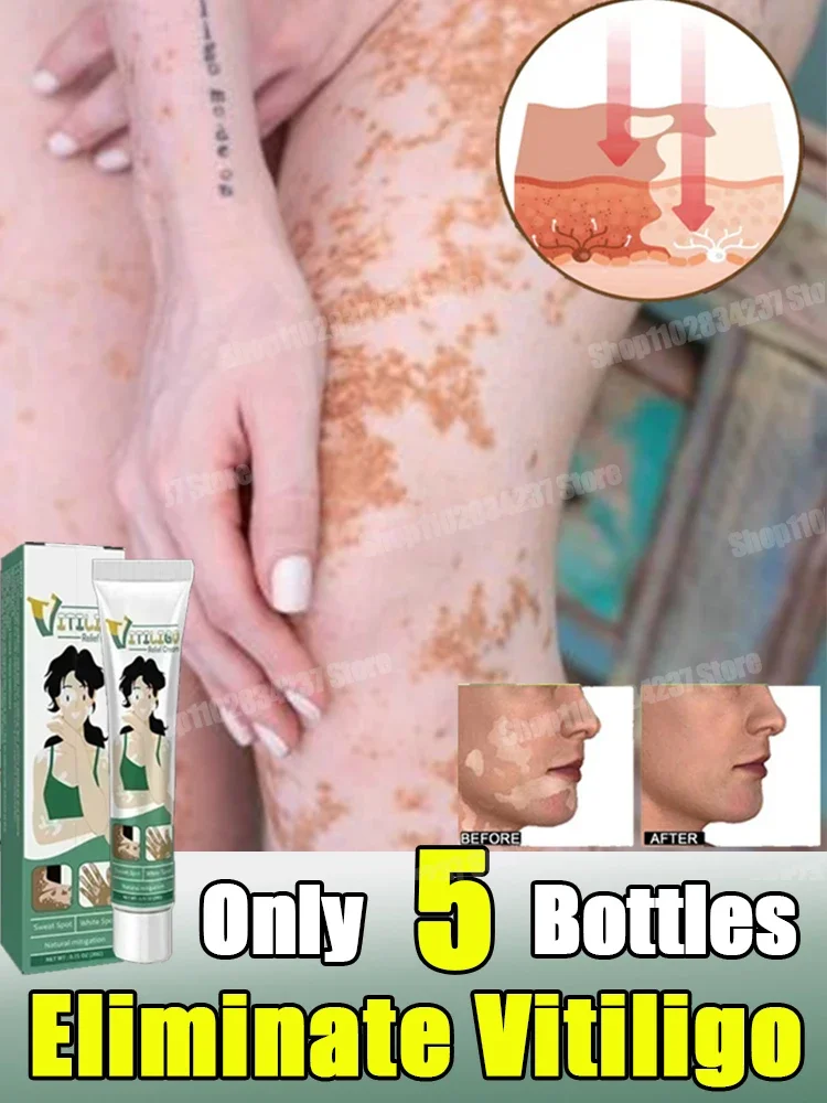 Vitiligo Removal Cream Vitiligo Cleansing Facial Care Skin Care Skin care-cream Reduces White Spots on Skin even