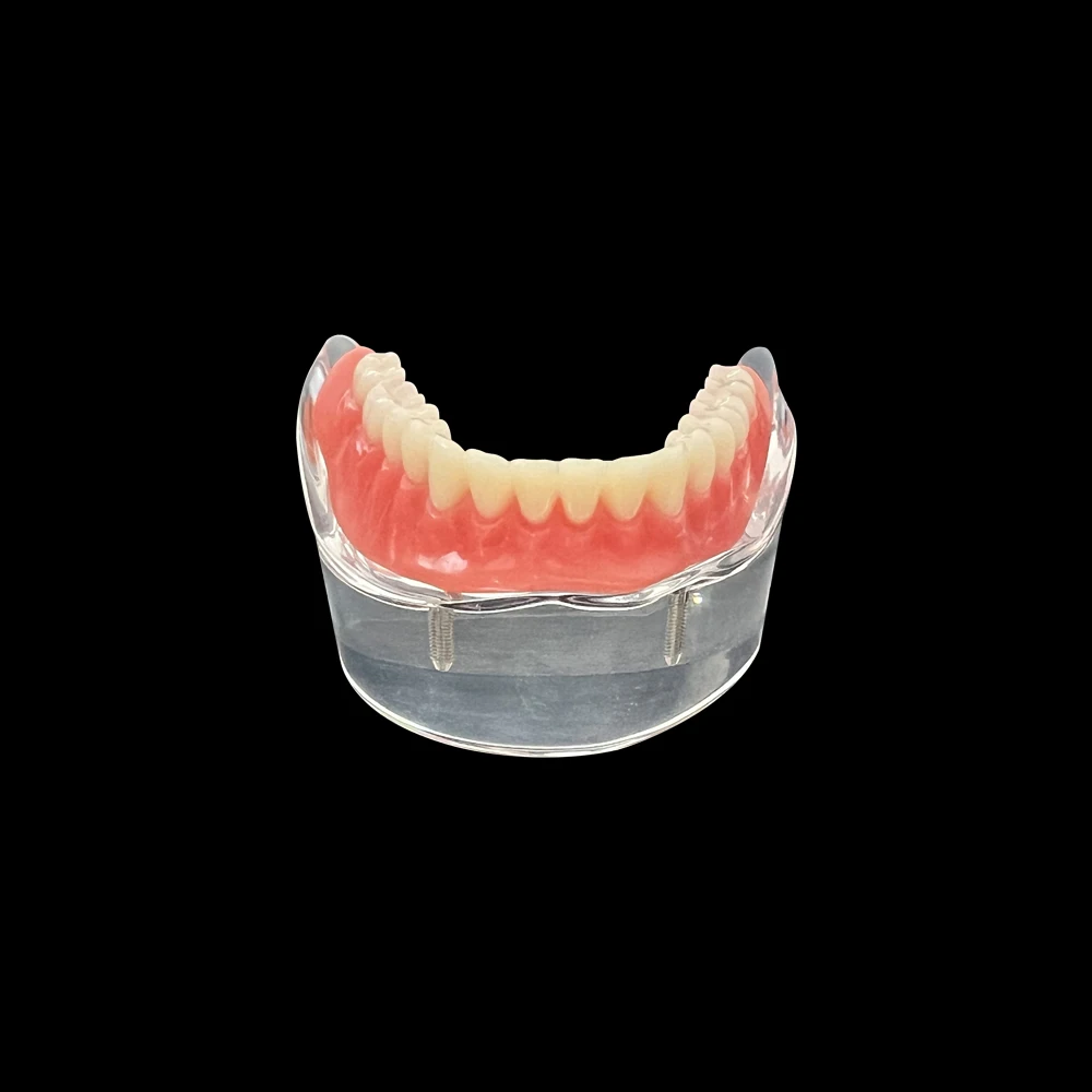 Dental Overdenture Teeth Model 2 Implants Demo Model 6002 Removable Restoration Dentist Student Learning Lower Model