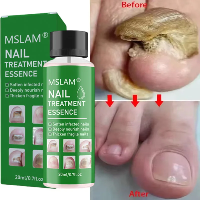 7 giorni Trattamento Fungo Delle Unghie Siero Riparazione Unghie Dei Piedi Rimozione Fungine Essenza Anti Infezione Paronichia Onicomicosi Assistenza Sanitaria