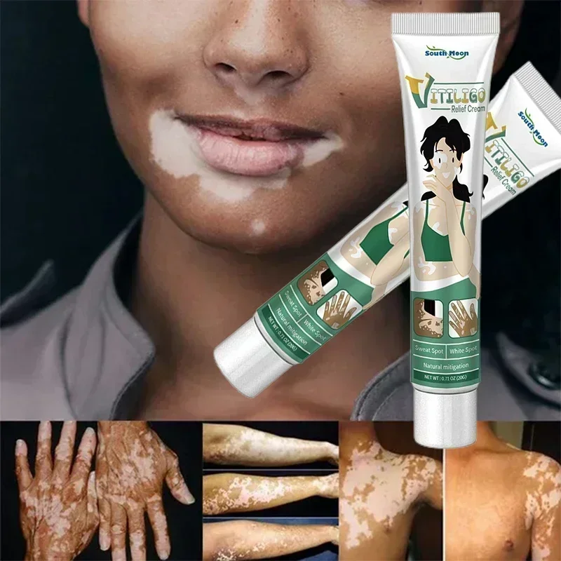 Vitiligo Remove Ringworm White Spot Gel Removal Skin Vitiligo Eliminate Vitiligo External Skin Care Cream