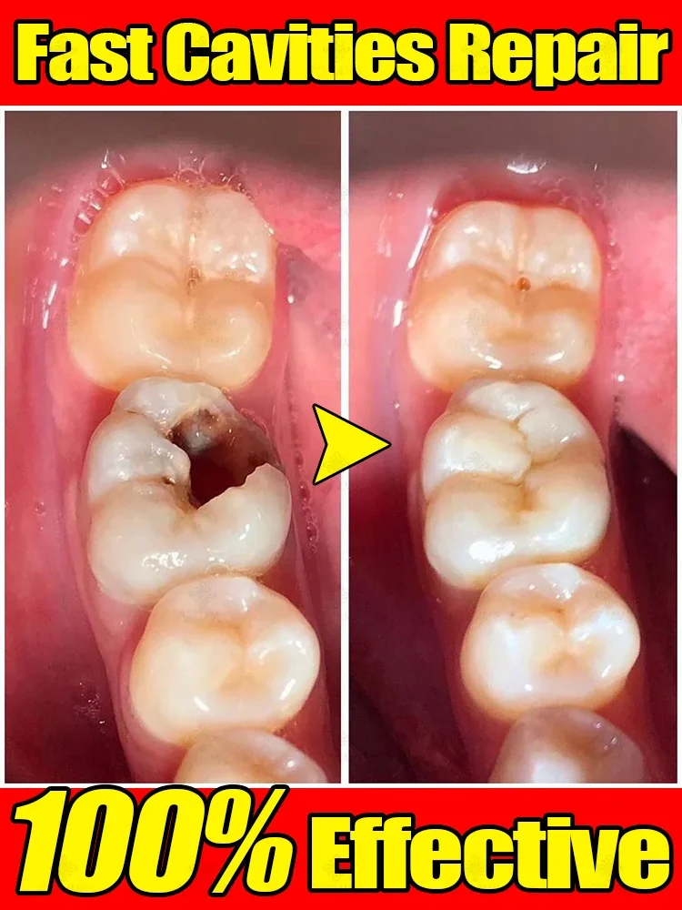 Anti-caries toothpaste whitens teeth