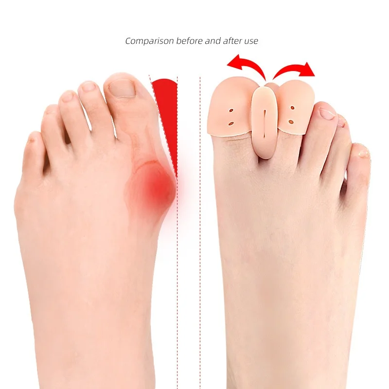 앞발 패드 이중 구멍 발가락 분리기 엄지 발가락 뼈 겹치는 발가락 분리기 부드러운 마찰 방지 발가락 보호대 발가락 클램프 엄지 발가락 패드