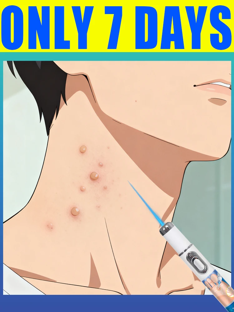 

dealwith warts get more smooth skin blue laser light pen wart care tools for smooth skin