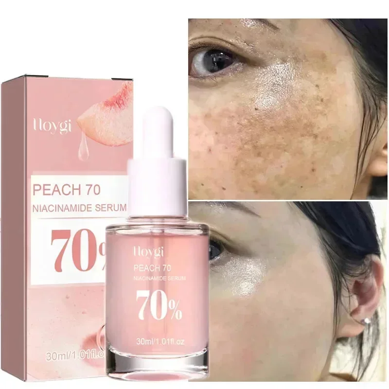 

Niacinamide Whitening Freckles Serum Removal Melasma Dark Spots Lighten Melanin Pigmentation Brightening Anti-Aging Beauty Care