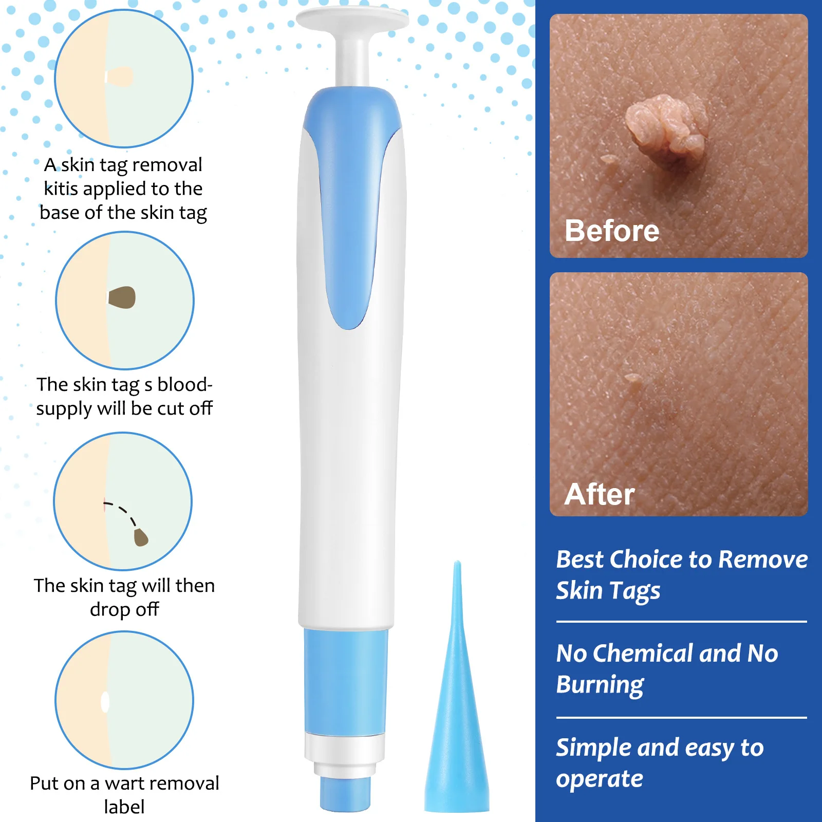2 In1 Painless Auto Skin Tag Mole Wart Removal Kit Cleaning Tools Face Skin Care Body Wart Dot Treatments Remover Beauty Health image 6