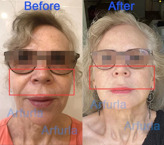 Fibra per lipolisi SMA 905 fibra di consumo medica 400um